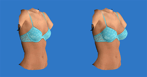 日式5D免按摩內視鏡隆乳：推薦透過3D Vectra影像模擬評估後，於手術前後真實與全方位比較