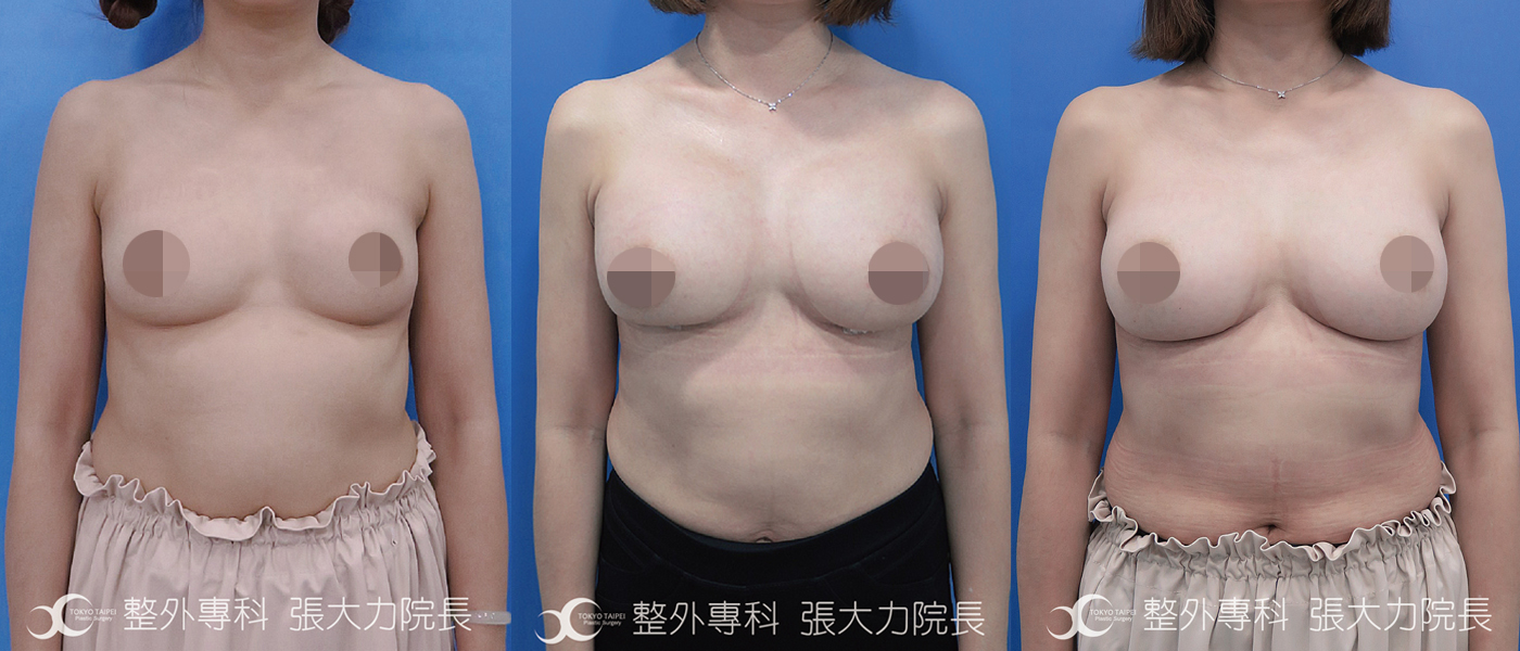 原自體脂肪隆乳因失敗-二次隆乳後術前術後（正面）