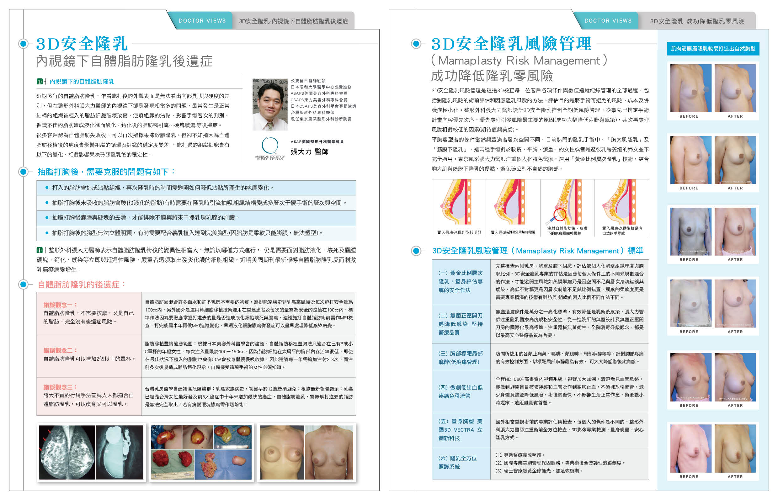3D安全隆乳 內視鏡下自體脂肪隆乳後遺症-雜誌專訪-張大力-整形名醫-東京風采