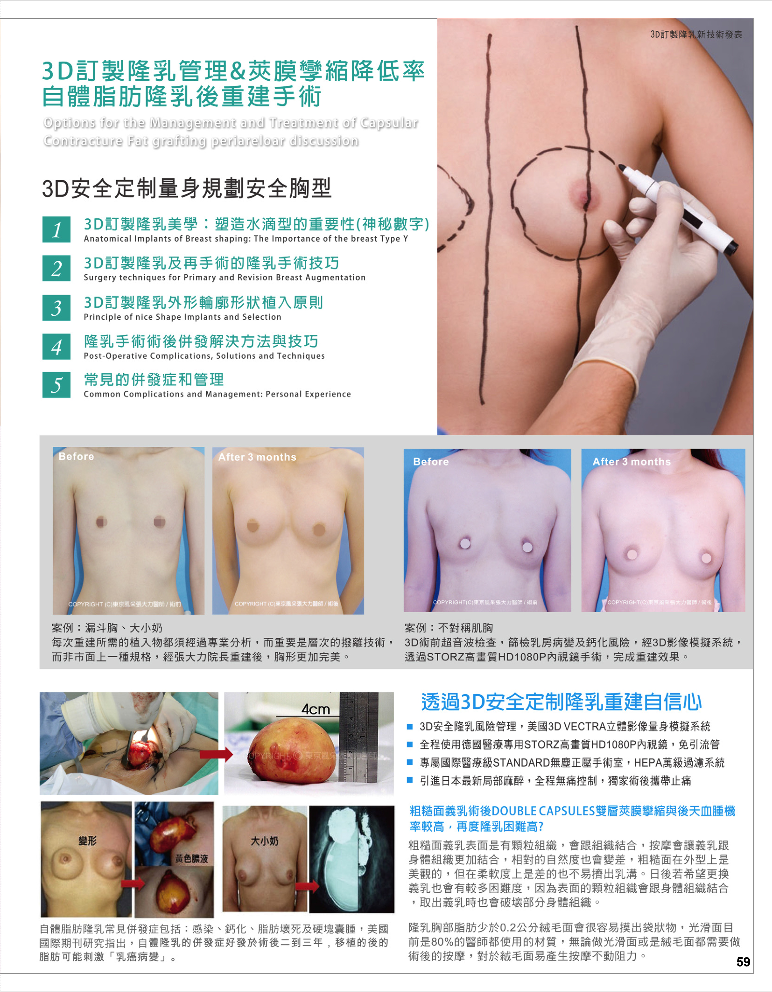 3D隆乳量身訂製蜜桃胸 -雜誌專訪-張大力-整形名醫-東京風采