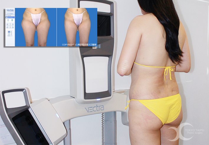 美國3D Vectra 立體影像