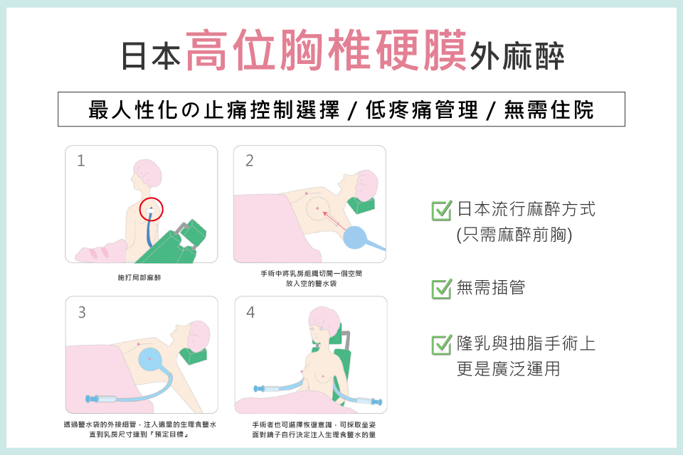 日本高位胸椎硬膜外麻醉