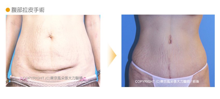 腹部拉皮手術