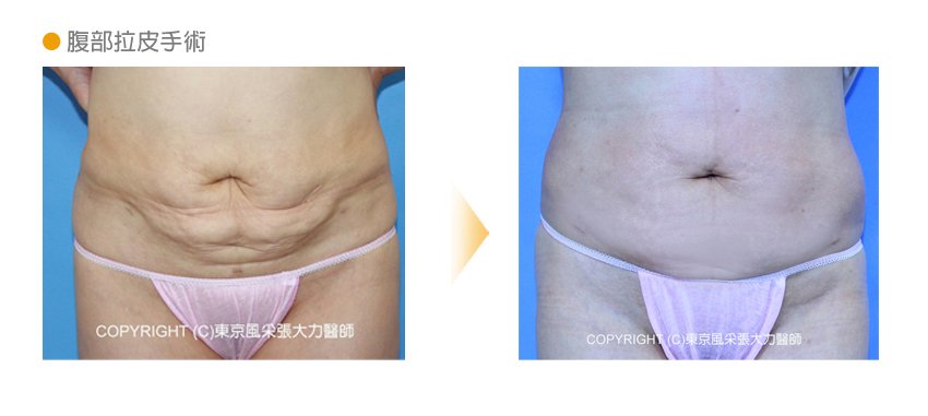 腹部拉皮手術