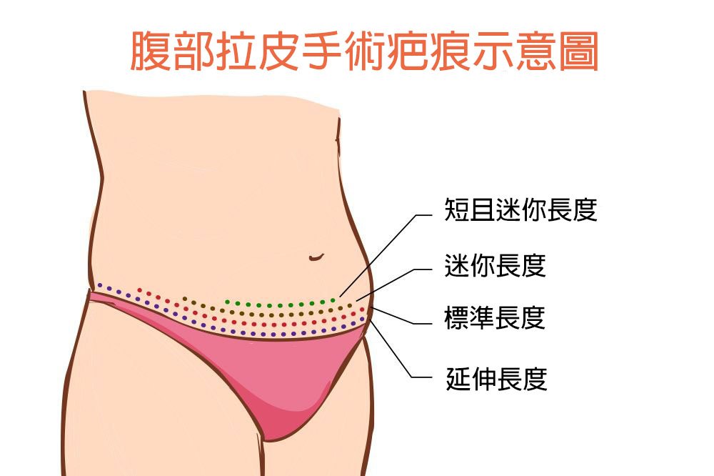 腹部拉皮手術疤痕示意圖